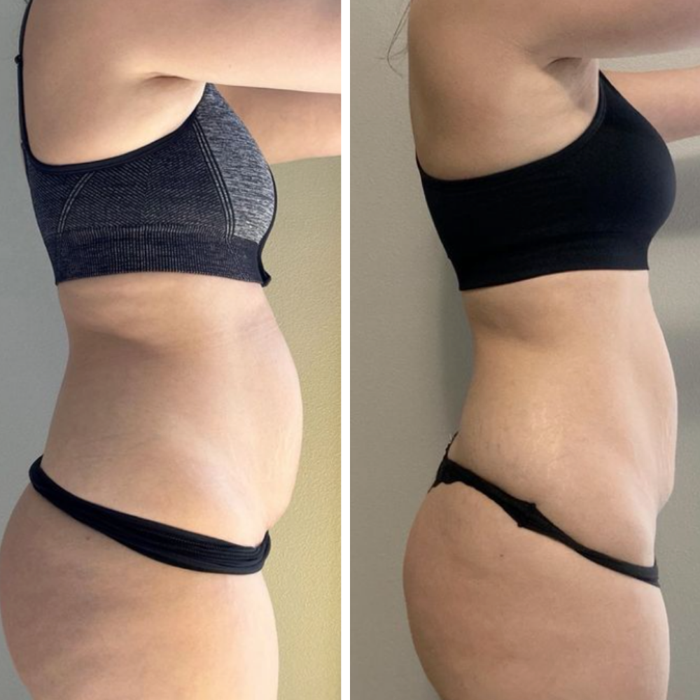 Ceradime Sculpt & Smooth Body System