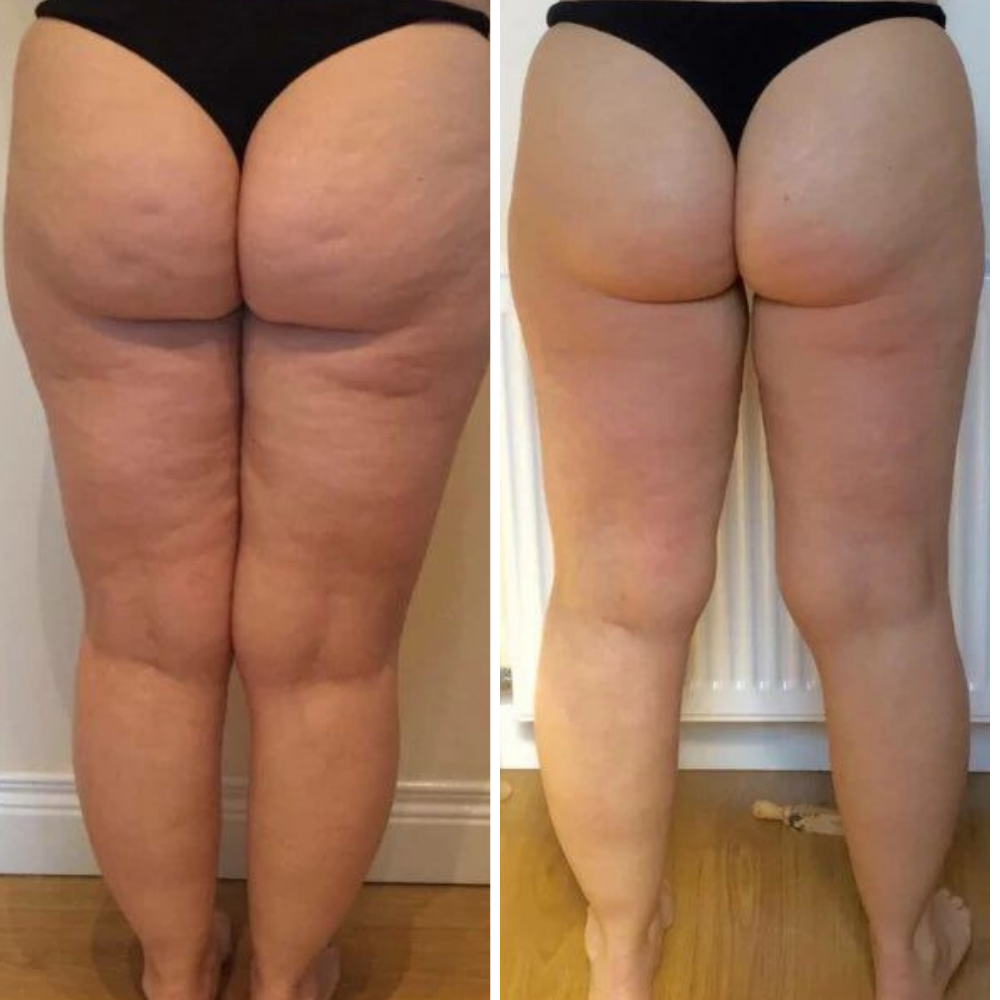 Ceradime Sculpt & Smooth Body System